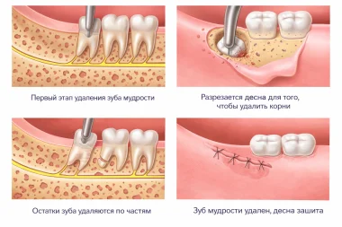 Удаление зуба мудрости